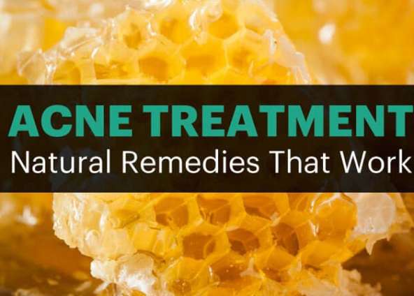 5 Natural Acne Treatments That Work