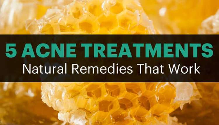 5 Natural Acne Treatments That Work