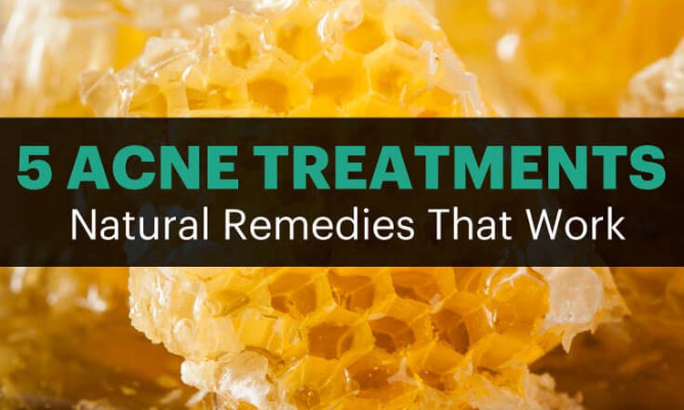 5 Natural Acne Treatments That Work