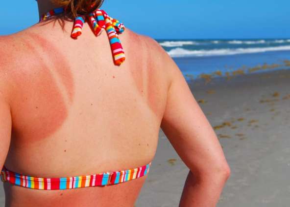 Natural Sunburn Relief You Haven’t Considered