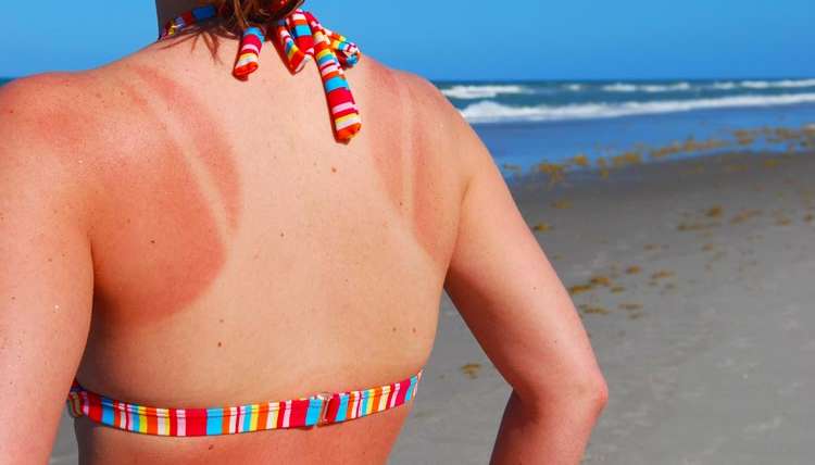 Natural Sunburn Relief You Haven’t Considered