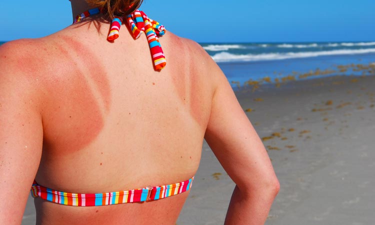 Natural Sunburn Relief You Haven’t Considered